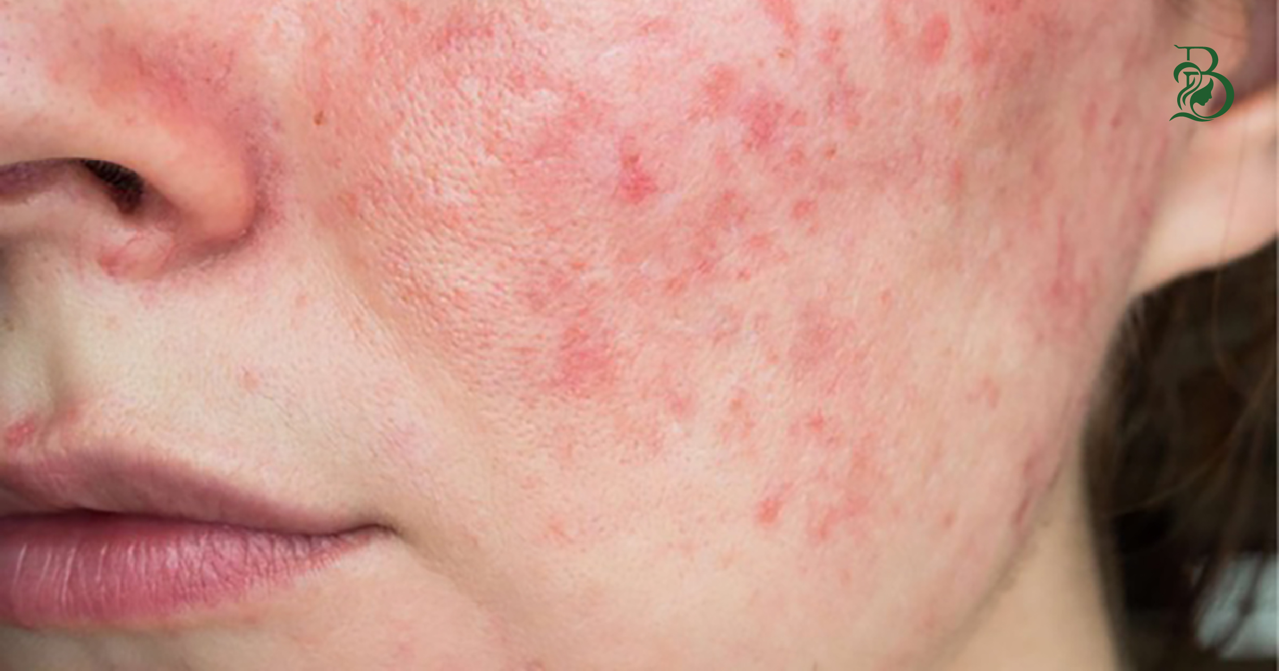 Chăm Sóc Da Dị Ứng Tại Thủ Dầu Một bị dị ứng